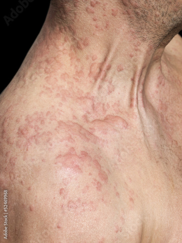 Photo: Man's shoulder covered with skin Allergy Man's shoulder covered with skin Allergy