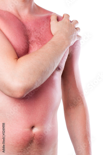 Photo: Man with a sunburn Man with a sunburn