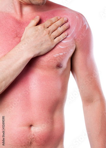 Photo: Man with a sunburn Man with a sunburn