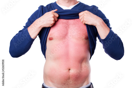 Photo: Man with a sunburn Man with a sunburn