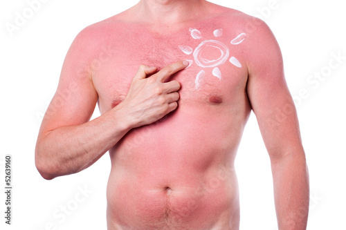 Photo: Man with a sunburn Man with a sunburn