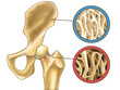 Osteoporosis