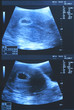 Ultrasound baby