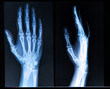 Xray of Hand/ fingers