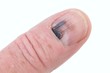 Foto: Human finger with black bruised nail diagonal isolated Human finger with black bruised nail diagonal isolated