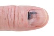 Foto: Human finger with black bruised nail isolated Human finger with black bruised nail isolated