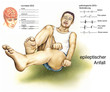 Illustration: Epilepsie.EEG.Krampf-Anfall Epilepsie.EEG.Krampf-Anfall
