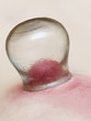 fire cupping treatment to cup sb therapy woman