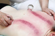 fire cupping treatment to cup sb therapy woman