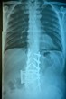 Spinal Injury Brace