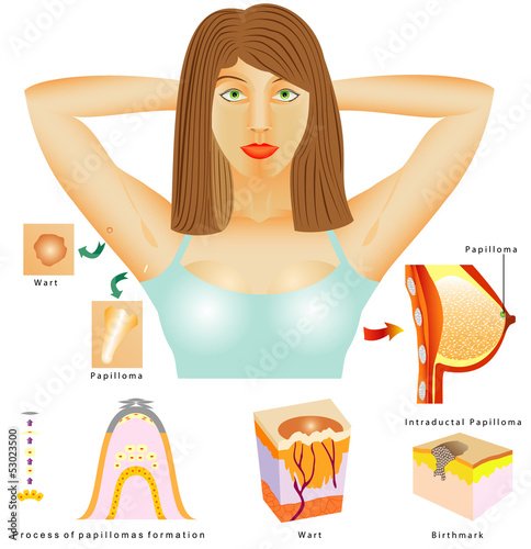 Vector: Human papilloma virus (HPV) Human papilloma virus (HPV)