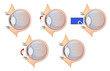 Laser eye correction