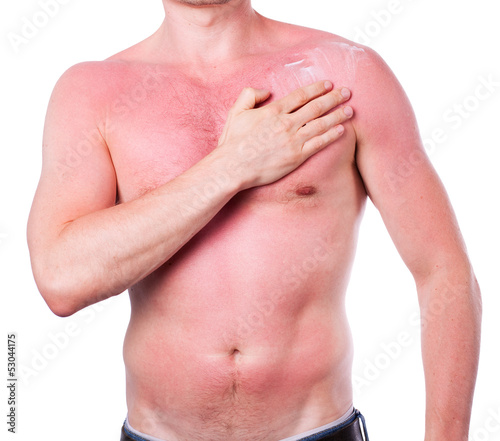 Photo: Man with a sunburn Man with a sunburn