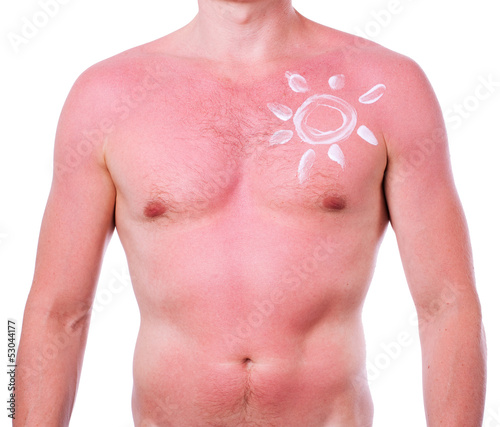 Photo: Man with a sunburn Man with a sunburn