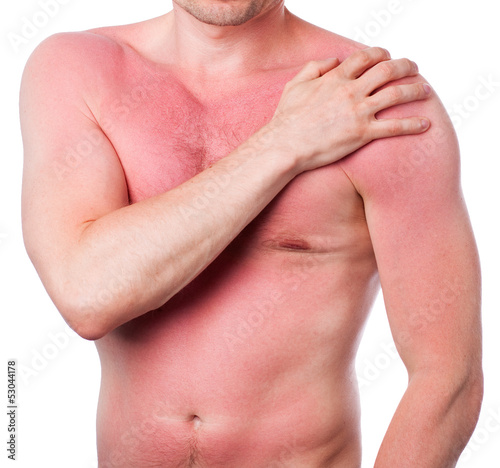 Photo: Man with a sunburn Man with a sunburn