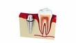 Anatomy of healthy teeth and dental implant in jaw bone.