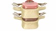 Prolapse of intervertebral disc