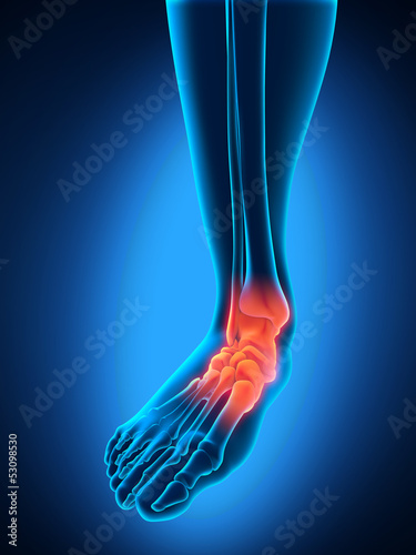 Illustration: Painful Foot Painful Foot