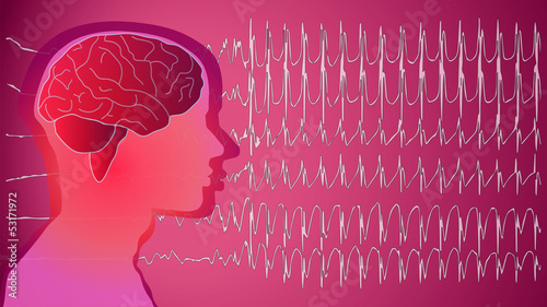 Vector: Epilepsie Patient Epilepsie Patient