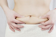cellulite