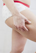 cellulite