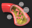 Diseased artery with fatty deposits