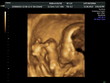 4D  ultrasound scan of a baby playing in the womb