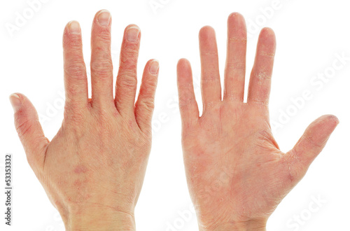 Photo: Eczema Dermatitis on Front and Back of Pair of Hands Eczema Dermatitis on Front and Back of Pair of Hands