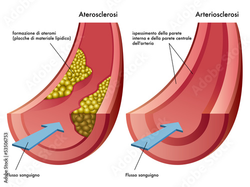 Vector: aterosclerosi & arteriosclerosi aterosclerosi & arteriosclerosi