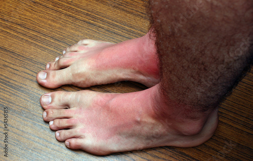 Photo: Sunburn feets Sunburn feets
