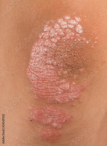 Photo: psoriasis psoriasis