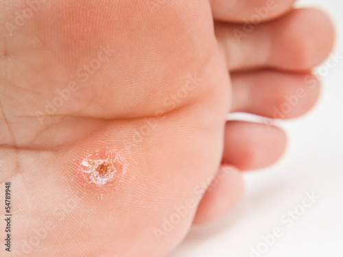 Photo: Callus under foot Callus under foot