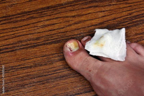 Photo: Ingrown toenail with dressing Ingrown toenail with dressing