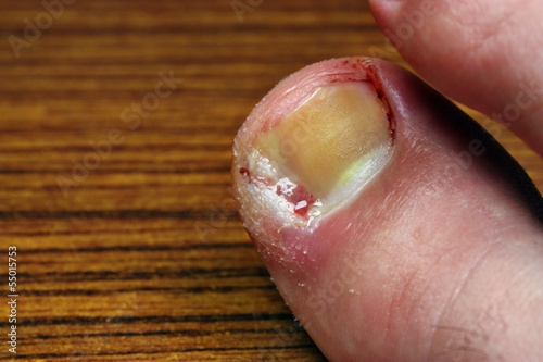 Photo: Ingrown toenail Ingrown toenail