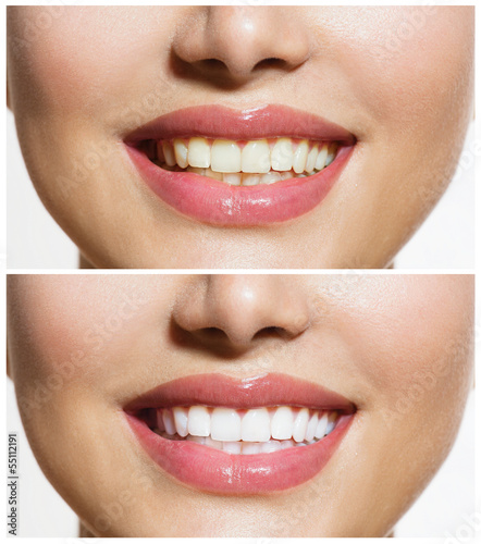 Photo: Woman Teeth Before and After Whitening. Oral Care Woman Teeth Before and After Whitening. Oral Care