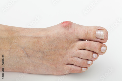 Photo: Bunion, isolated background Bunion, isolated background