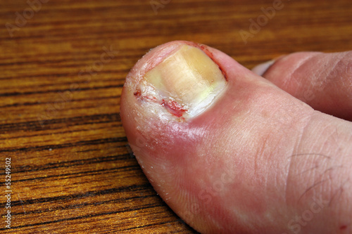 Photo: Infection in the nail toe Infection in the nail toe