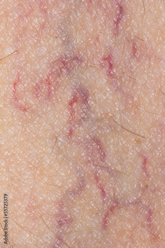 Photo: varicose veins on the skin. Macro varicose veins on the skin. Macro