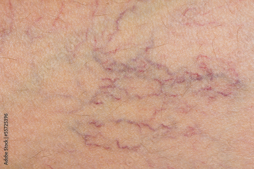 Photo: varicose veins on the skin. Macro varicose veins on the skin. Macro