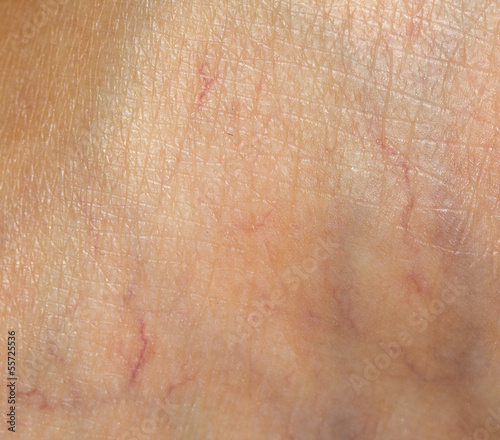 Photo: varicose veins on the skin. Macro varicose veins on the skin. Macro