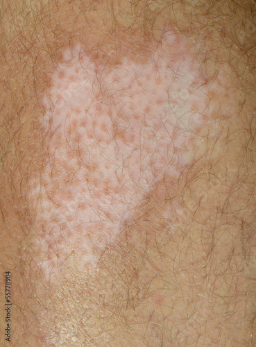 Photo: Vitiligo Spot on the Leg Vitiligo Spot on the Leg