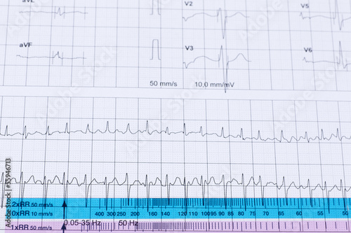 Photo: Cardiogram pulse trace and a ruler Cardiogram pulse trace and a ruler