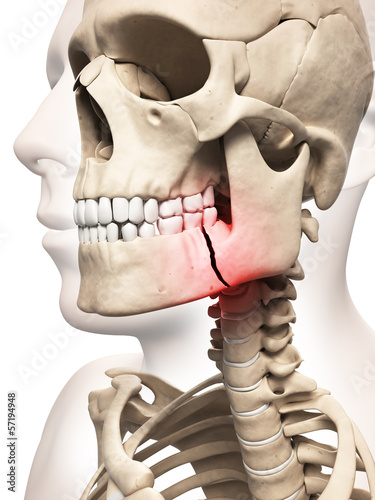 Illustration: medical illustration of a broken jaw bone medical illustration of a broken jaw bone