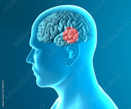 Illustration: Cervello malattie degenerative Parkinson Cervello malattie degenerative Parkinson