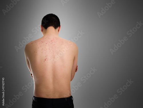 Photo: Acne, scars, keloids, skin disease Acne, scars, keloids, skin disease