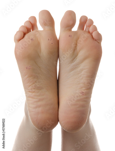 Photo: Feet, plantar warts, skin disease, dermatology Feet, plantar warts, skin disease, dermatology