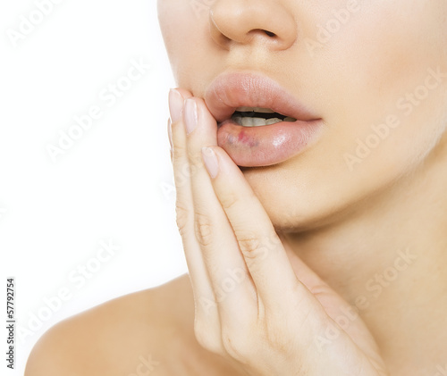 Photo: real lip bruise after injection real lip bruise after injection