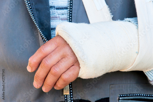 Photo: Broken hand Broken hand