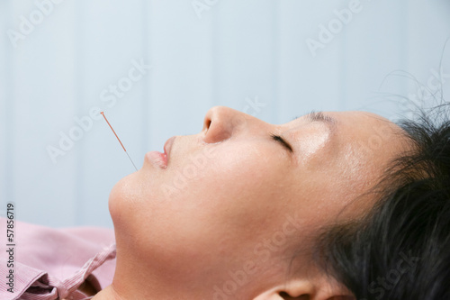 Photo: Electrical stimulating acupuncture treatment for an asian woman Electrical stimulating acupuncture treatment for an asian woman