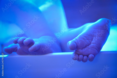 Photo: Newborn jaundice Newborn jaundice